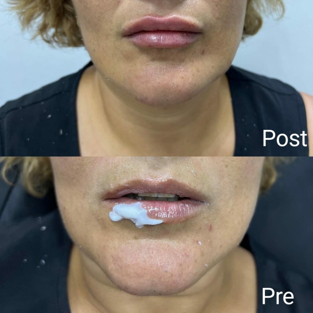 Lip flip botox